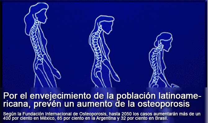 Por el envejecimiento de la población latinoamericana, prevén un aumento de la osteoporosis